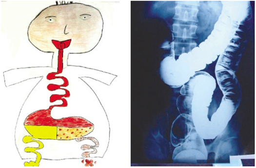 Kinderzeichnung und Röntgenaufnahme des menschlichen Verdauungstraktes