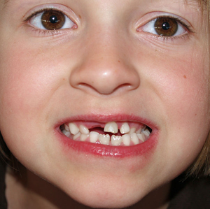 Kind mit ausgefallenem Zahn